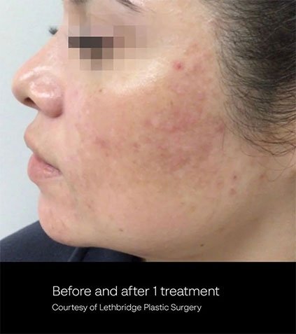 out-put-of-elate-treatment