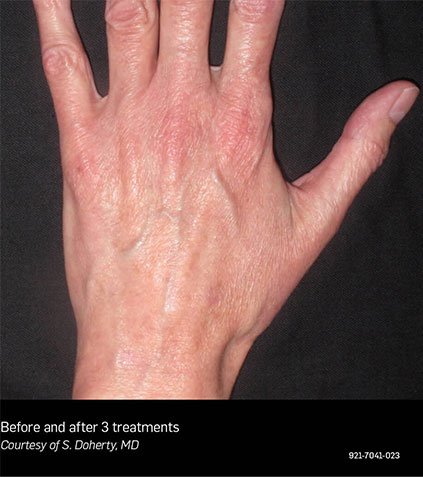 vein-removal-1-B