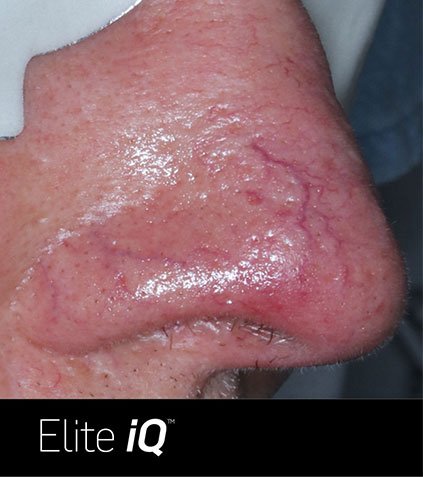 vein-removal-2-A