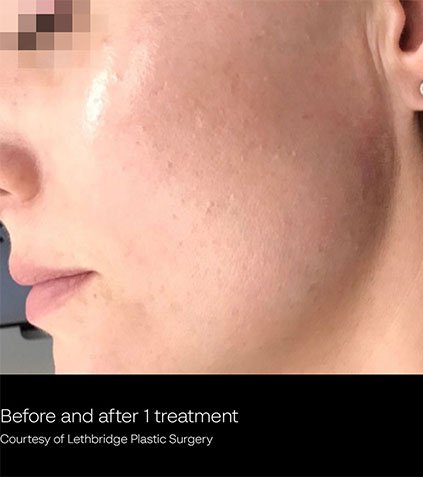 vein-removal-3-B