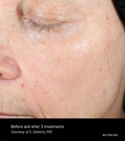 BA 004 vein and pigmentation_After