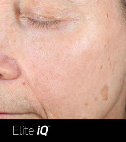 BA 004 vein and pigmentation_Before